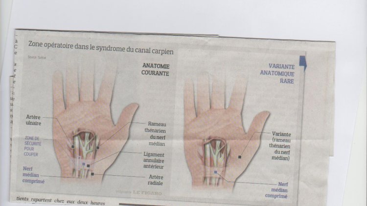 Pour les douleurs de la main  dit "Canal Carpien" jusque là c'était de grandes et peu esthétiques cicatrices.